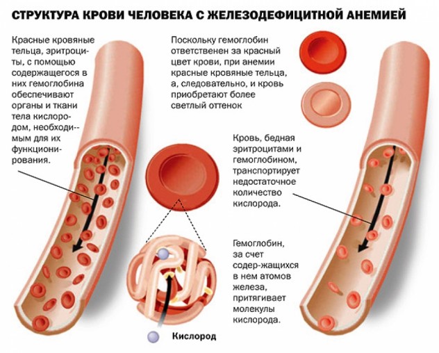 структура крови при железодефицитной анемии