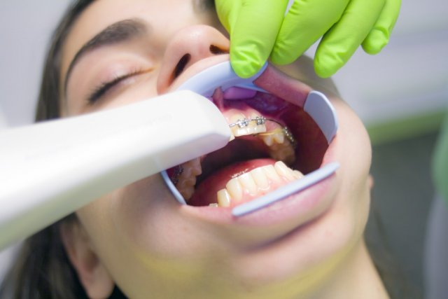 Эффективные методы борьбы с налетом на зубах